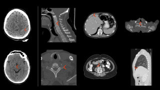 Aidoc’s AI Algorithm Receives FDA Approval for Flagging Pulmonary Embolisms in Radiology