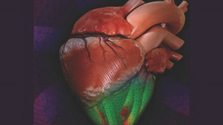 Soft Robotic Cardiac Device Prevents Heart Failure