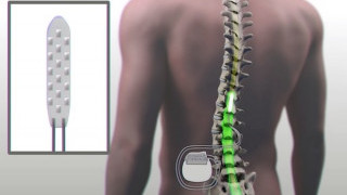 Mayo Clinic Demonstrates Ability of Implantable Device to Help Paralyzed Man Walk Again