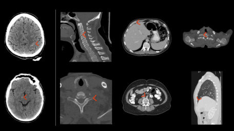 Aidoc’s AI Algorithm Receives FDA Approval for Flagging Pulmonary Embolisms in Radiology