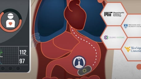 Ingestible Sensor Completes First In-Human Trial to Monitor Vital Signs