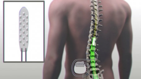 Mayo Clinic Demonstrates Ability of Implantable Device to Help Paralyzed Man Walk Again