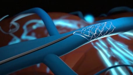 Startup Leaps Ahead of Neuralink With First Human BCI Implant